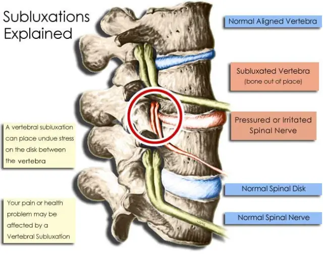 Illustration explaining a vertebral subluxation