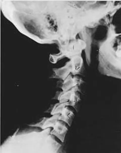 Side x-ray of a near-normal neck