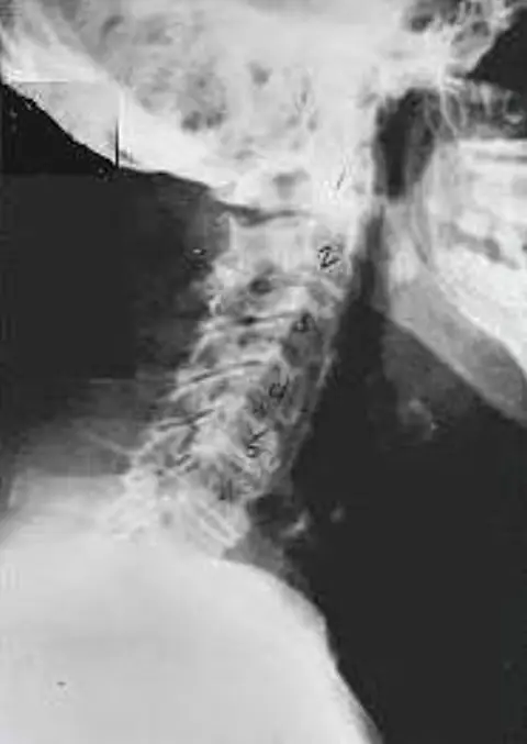 Side x-ray of a neck showing phase four subluxation degeneration