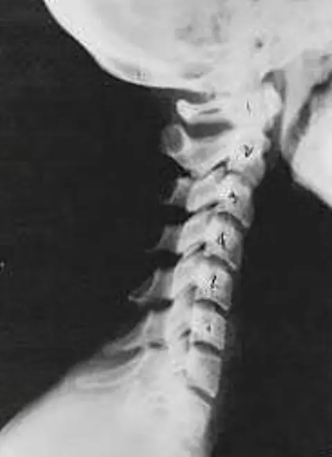 Side x-ray of a neck showing phase one subluxation degeneration