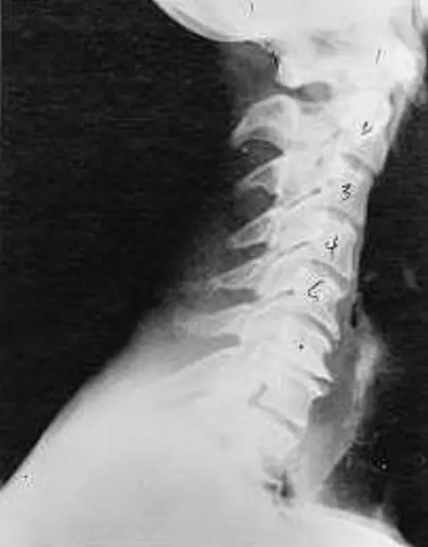 Side x-ray of a neck showing phase three subluxation degeneration
