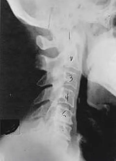 Side x-ray of a neck showing phase two subluxation degeneration