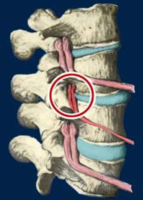 Subluxation degeneration representation