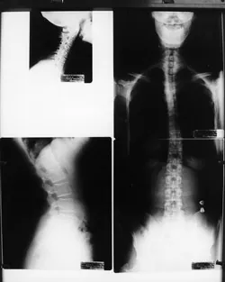 Spinal x-rays